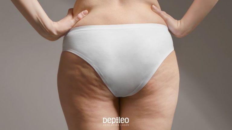 Mujer con celulitis antes de iniciar tratamientos en Depileo.