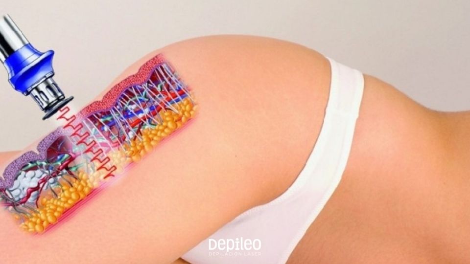 Ondas de choque para celulitis en los centros de estética Depileo. Tratamiento de ondas de choque en centro de estética avanzada.
