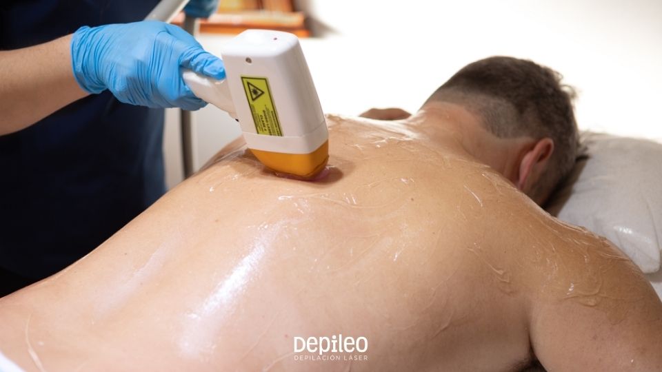 Espalda masculina tratada con depilación láser SHR en Cartagena Espalda masculina siendo tratada con láser para eliminar el vello en Cartagena.